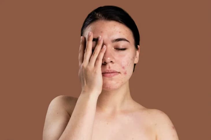Kā ārstēt akni pieaugušajiem? Dermatologa ieteikumi