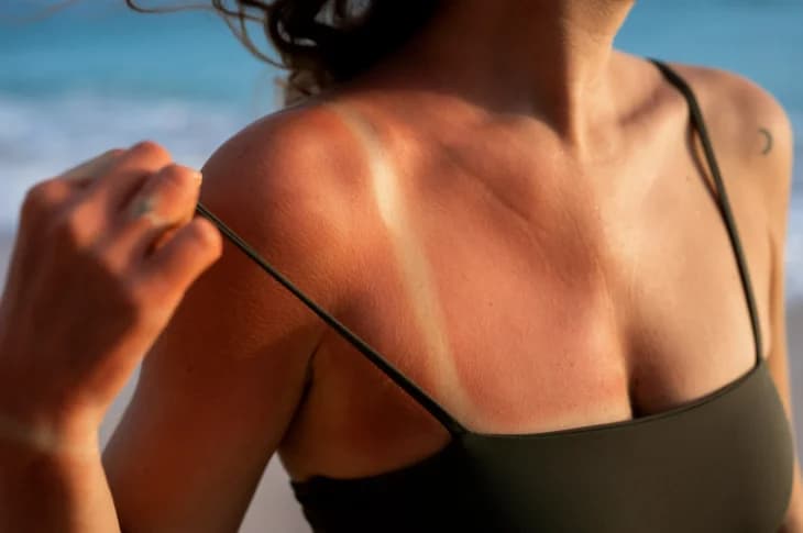 Skin Care After Sun Solarium: Dermatologist Tips