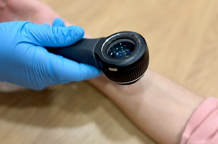 Kā notiek dzimumzīmju pārbaude ar dermatoskopu?