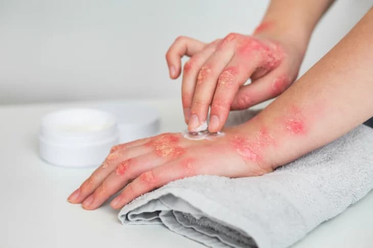 Dry Skin or Eczema? How Distinguish Symptoms Act